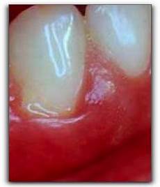 Blister Marble Gum